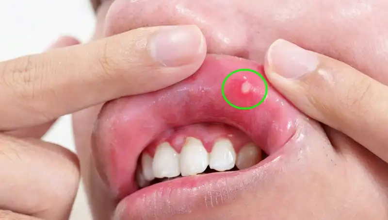 Vücudunuzdaki B Vitamini Eksikliğini Gösteren 5 Belirgin İşaret